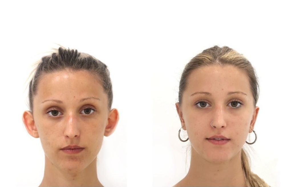 Otoplastia caso 2 — antes y después
